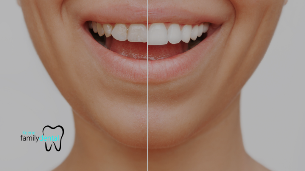 Same-Day Dental Crowns