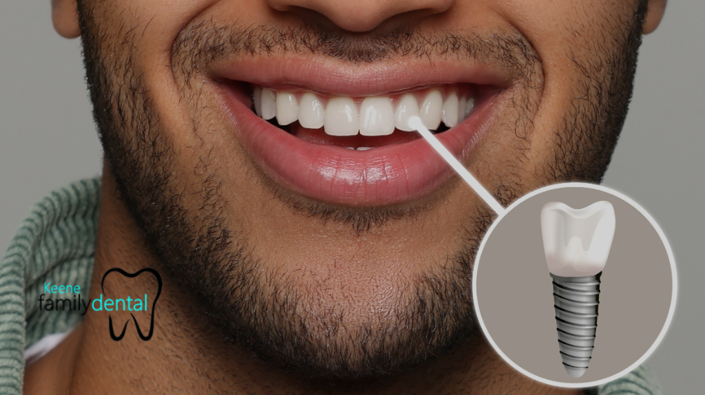 How Long Do Dental Implants Last?