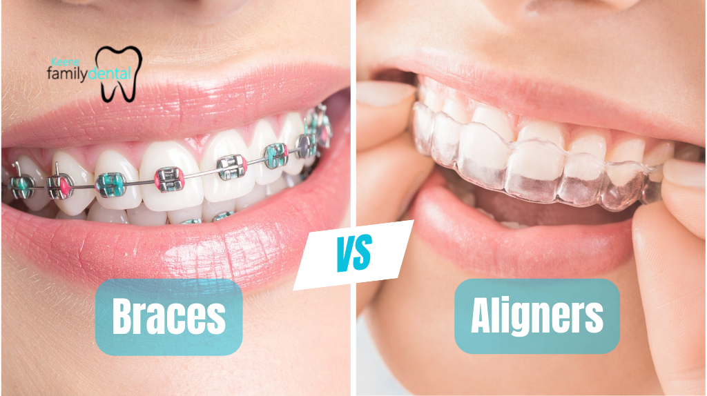 Invisalign vs Braces blog