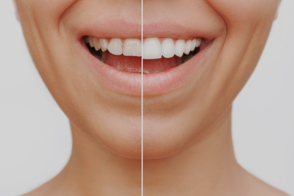 Patient with a confident smile after dental veneers at Keene Family Dentistry