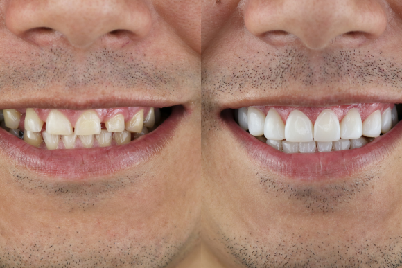 Veneer consultation at Keene Family Dentistry serving Keene, Cleburne, Burleson, and Alvarado, TX