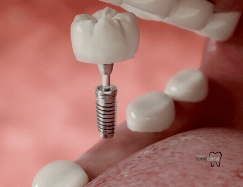 Animated illustration of a dental implant being placed in the jawbone